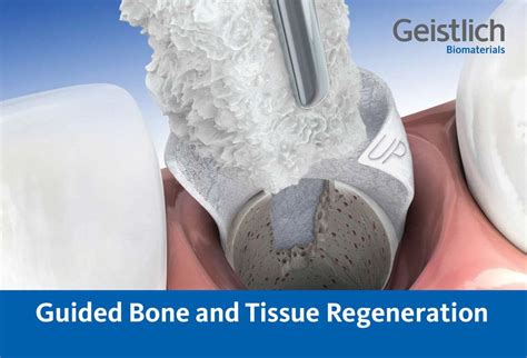 Guided Bone and Tissue Regeneration .